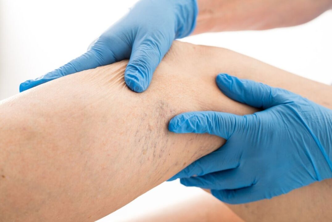 Clinical cardinal varicose veins disease