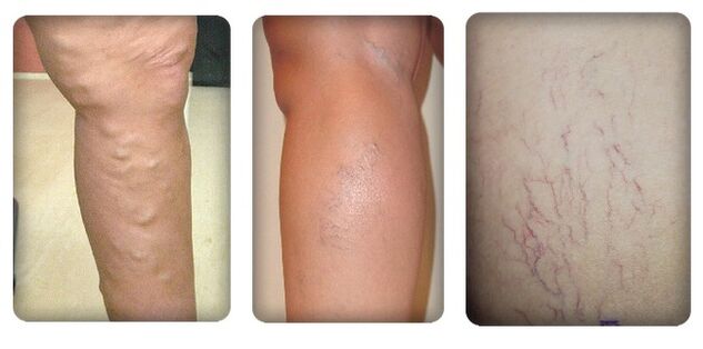 The stage of varicose veins