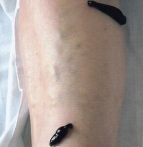 Rest therapy as a way to treat varicose veins