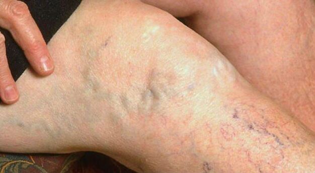 Obvious symptoms of varicose veins in the legs