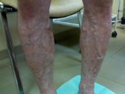 Varicose veins in legs
