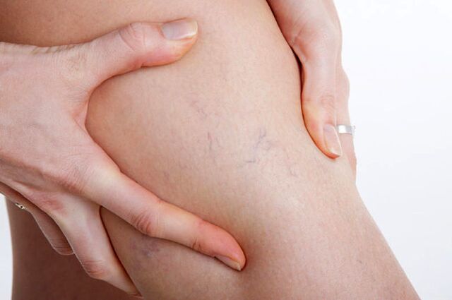 First appearance of varicose veins in the legs