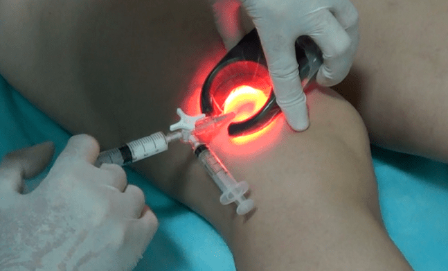 Sclerotherapy is an effective treatment for varicose veins in the legs