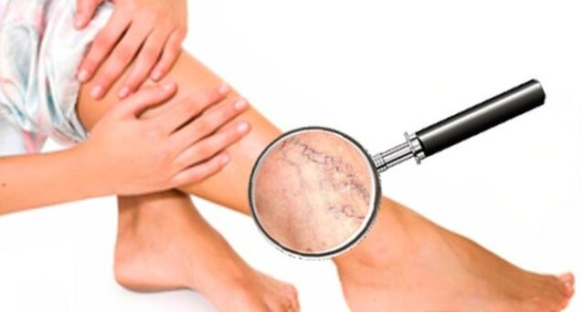 Varicose veins in legs