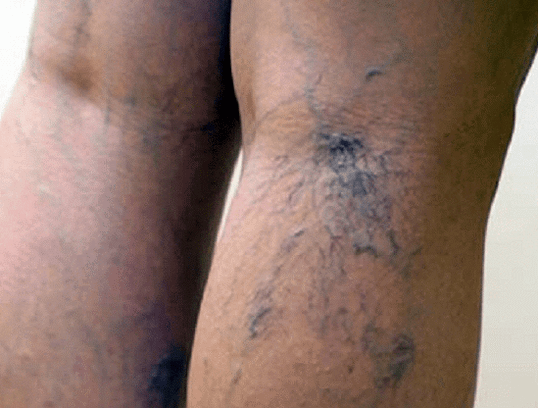 Varicose veins in legs